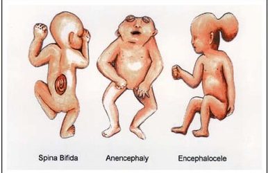 Defectele de tub neural