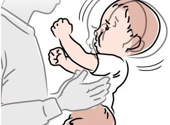 Sindromul copilului zgaltait / Shaken baby syndrome