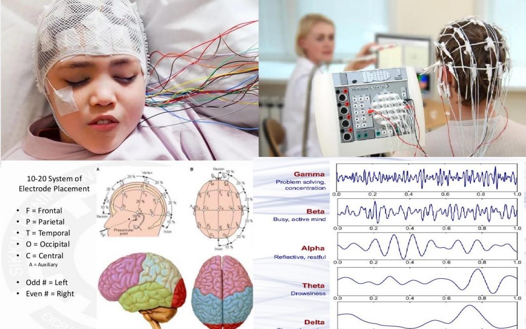 Electroencefalograma – EEG