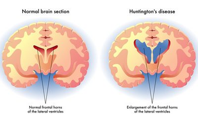 Correa Huntington / Boala Huntington (BH)