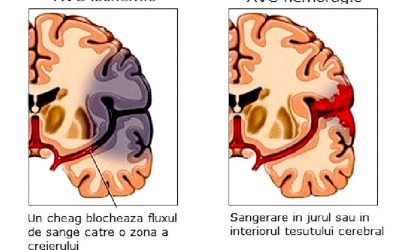 Accidentul vascular cerebral (AVC)