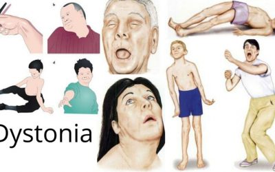 Distonia