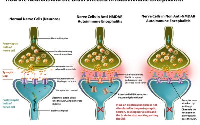 Encefalitele autoimune