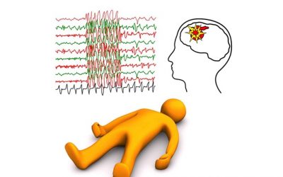 Epilepsia