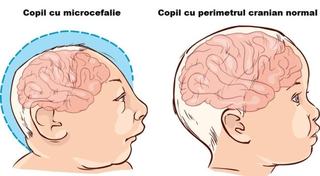Microcefalia