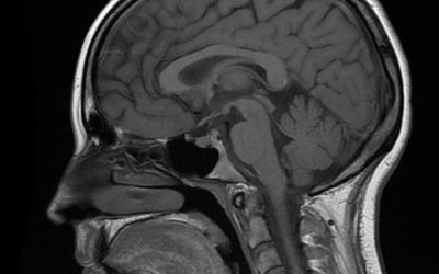 Malformatii ale sistemului nervos central – Anomalii de linie mediana