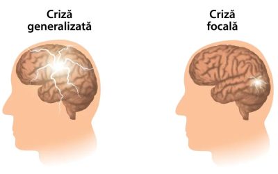 Epilepsia – cauze, tratament