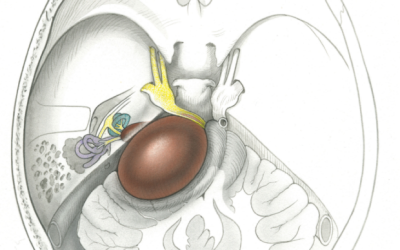 Neurinomul acustic (schwannom vestibular)