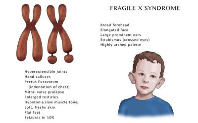 Sindromul X fragil
